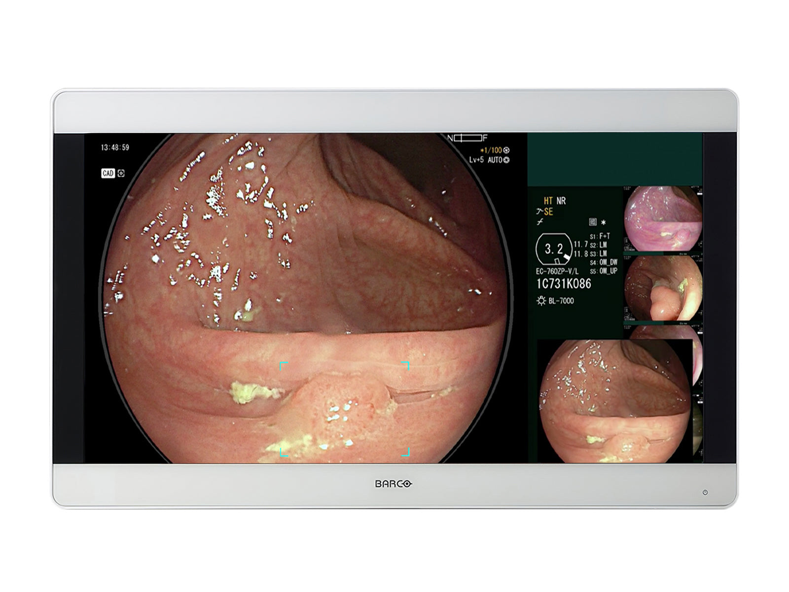 Barco MDSC-8331 31” 8MP 4K UHD Color Surgical Medical Display Monitor (991932399111)