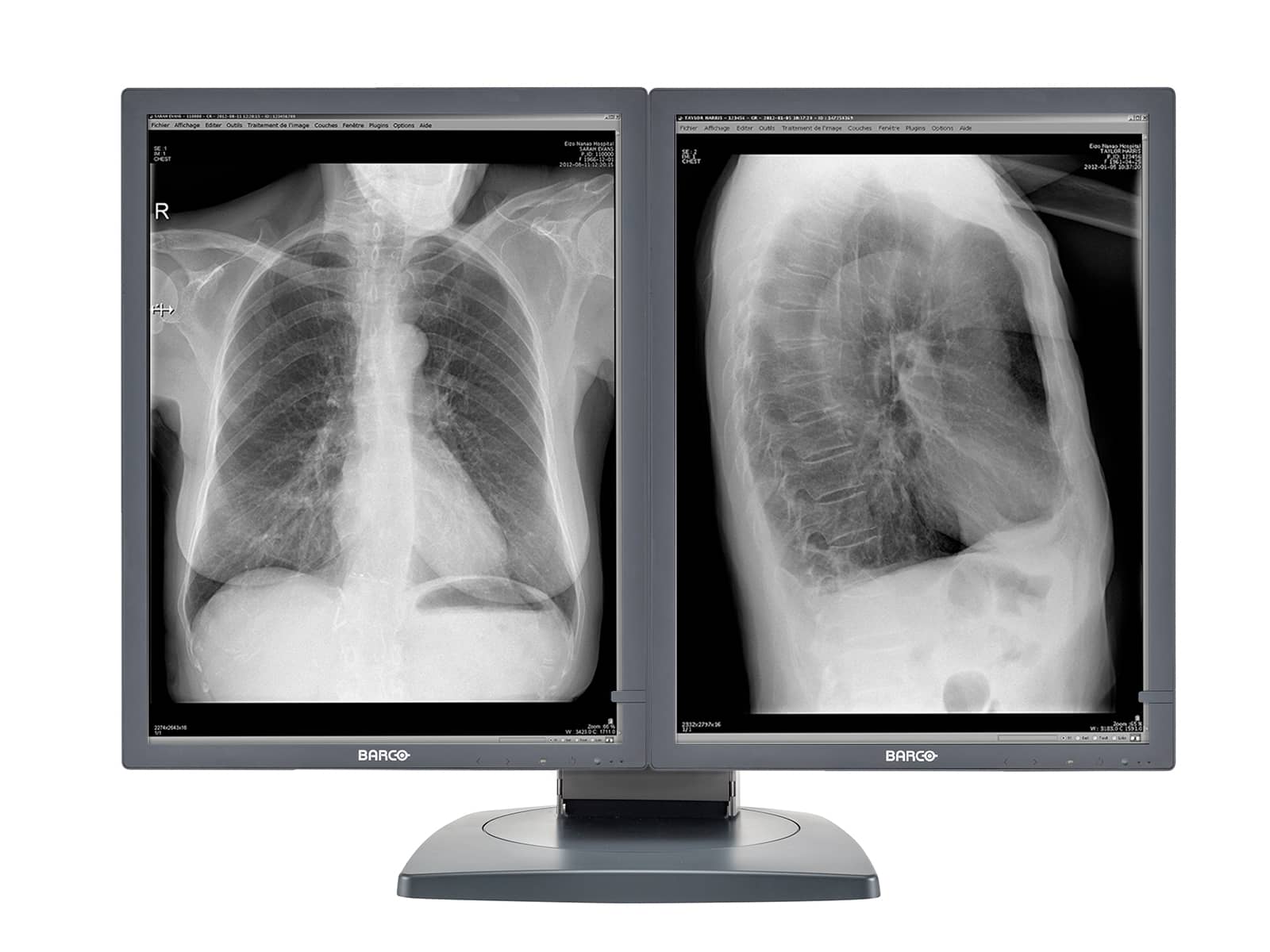 Barco Coronis MDCG-3120 3MP 20.8" Grayscale General Radiology Diagnostic Display Monitors.com 