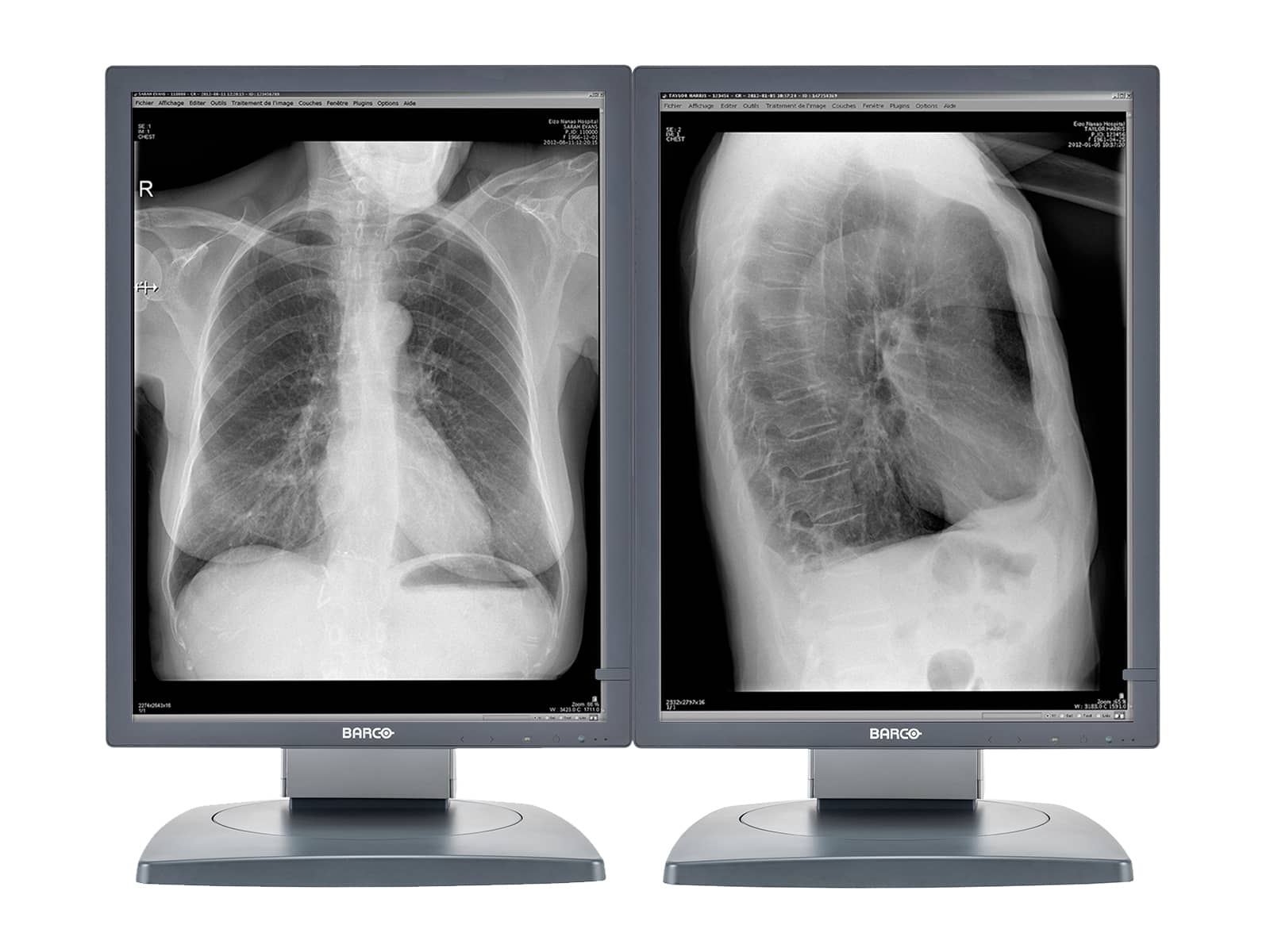 Barco Coronis MDCG-3120 3MP 20.8" Grayscale General Radiology Diagnostic Display Monitors.com 